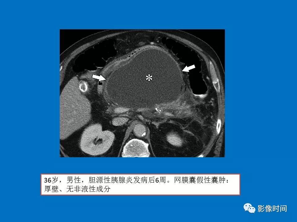 【PPT】急性胰腺炎相关知识更新