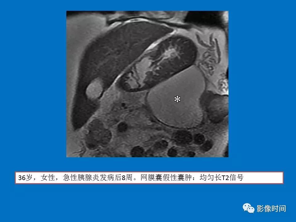 【PPT】急性胰腺炎相关知识更新