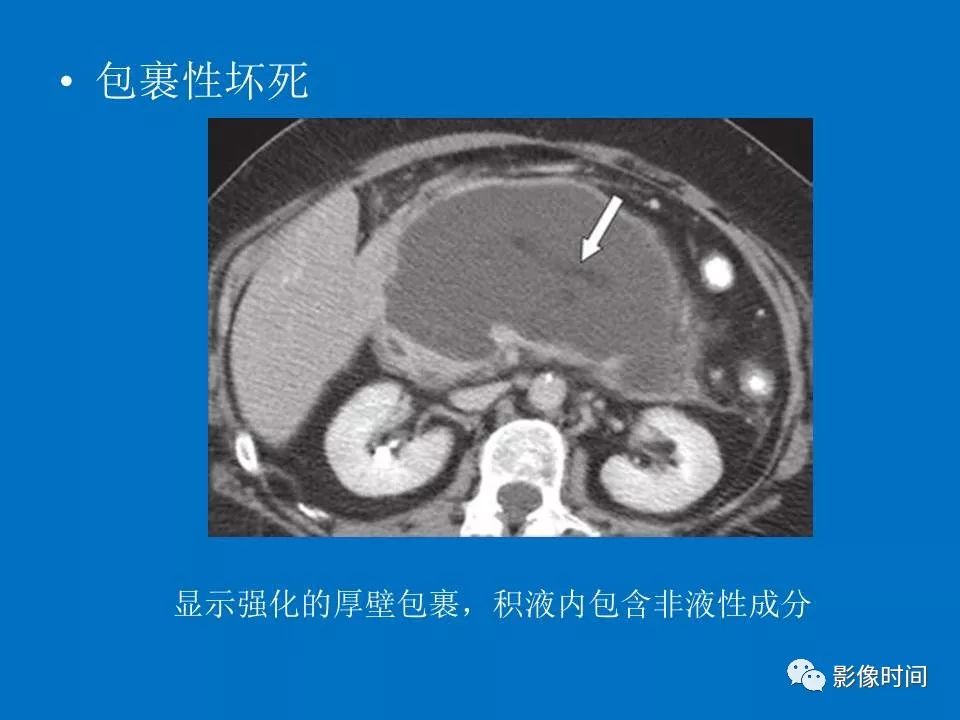 【PPT】急性胰腺炎相关知识更新