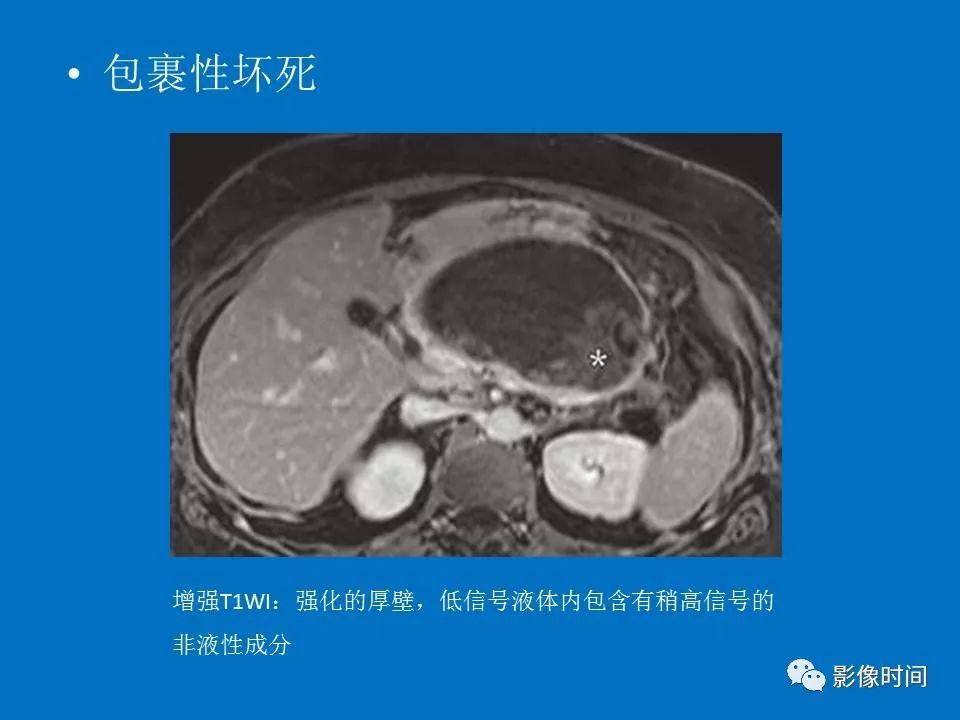 【PPT】急性胰腺炎相关知识更新