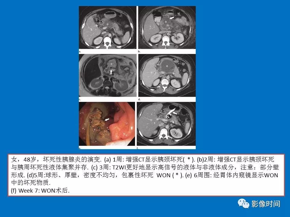 【PPT】急性胰腺炎相关知识更新