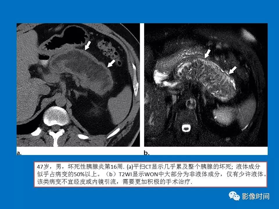 【PPT】急性胰腺炎相关知识更新