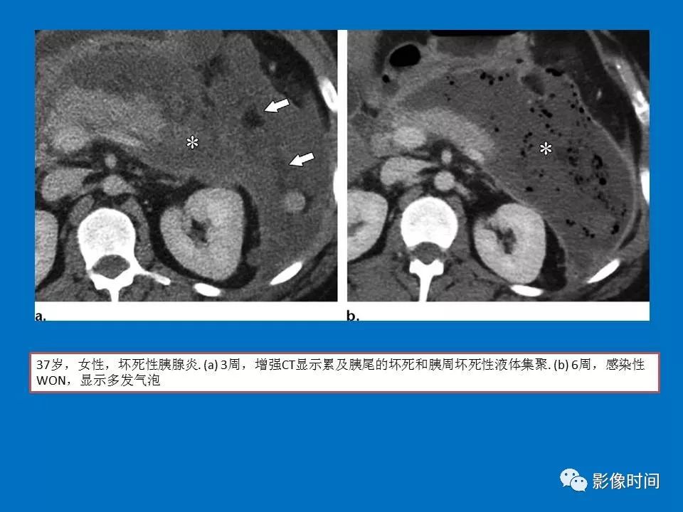 【PPT】急性胰腺炎相关知识更新