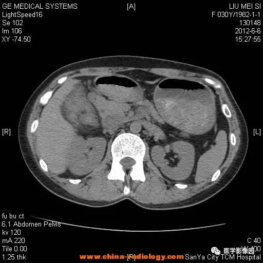 【病例】胆囊腺肌增生症1例CT影像表现 【病例】胆囊腺肌增生症1例CT影像表现