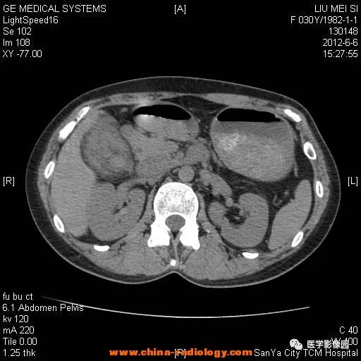 【病例】胆囊腺肌增生症1例CT影像表现 【病例】胆囊腺肌增生症1例CT影像表现