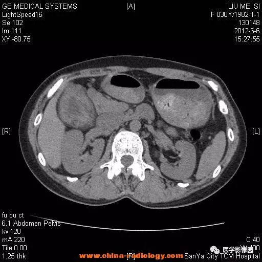 【病例】胆囊腺肌增生症1例CT影像表现 【病例】胆囊腺肌增生症1例CT影像表现