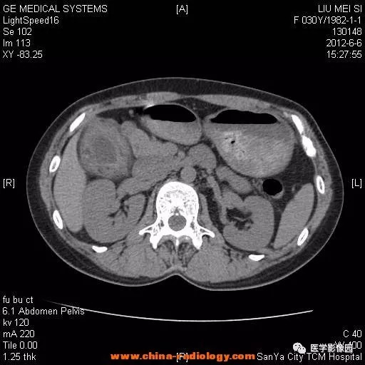 【病例】胆囊腺肌增生症1例CT影像表现 【病例】胆囊腺肌增生症1例CT影像表现