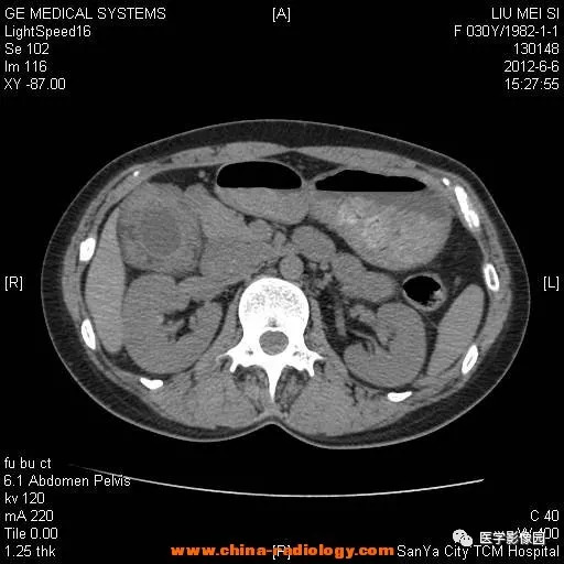 【病例】胆囊腺肌增生症1例CT影像表现 【病例】胆囊腺肌增生症1例CT影像表现