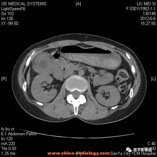 【病例】胆囊腺肌增生症1例CT影像表现 【病例】胆囊腺肌增生症1例CT影像表现