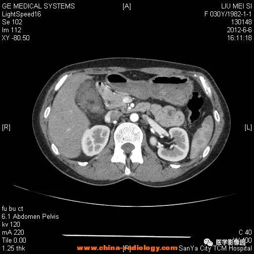 【病例】胆囊腺肌增生症1例CT影像表现 【病例】胆囊腺肌增生症1例CT影像表现