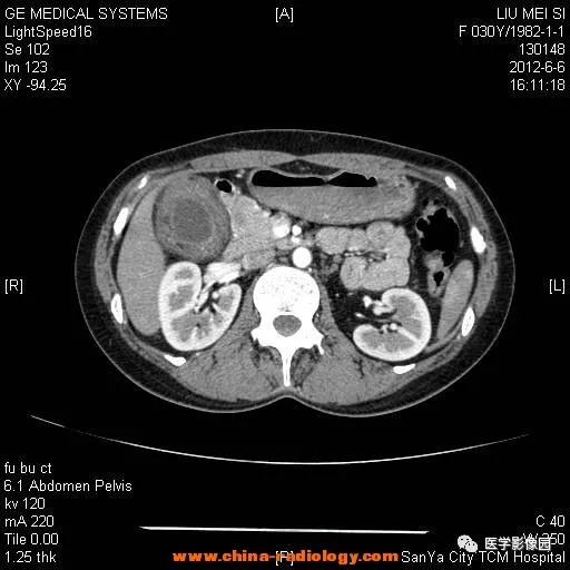 【病例】胆囊腺肌增生症1例CT影像表现 【病例】胆囊腺肌增生症1例CT影像表现