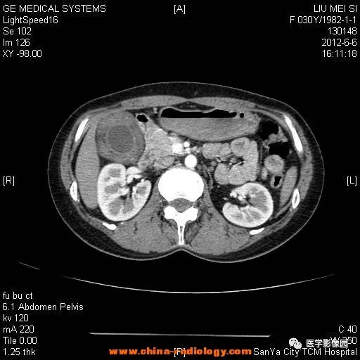 【病例】胆囊腺肌增生症1例CT影像表现 【病例】胆囊腺肌增生症1例CT影像表现