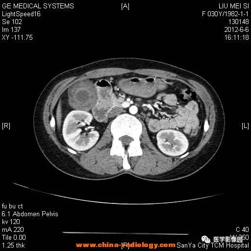 【病例】胆囊腺肌增生症1例CT影像表现 【病例】胆囊腺肌增生症1例CT影像表现