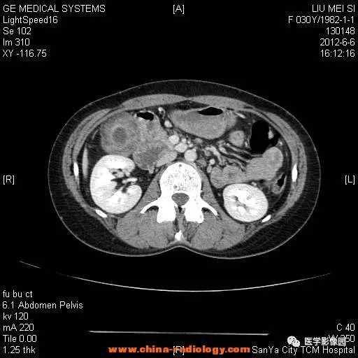 【病例】胆囊腺肌增生症1例CT影像表现 【病例】胆囊腺肌增生症1例CT影像表现