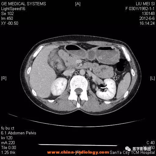 【病例】胆囊腺肌增生症1例CT影像表现 【病例】胆囊腺肌增生症1例CT影像表现