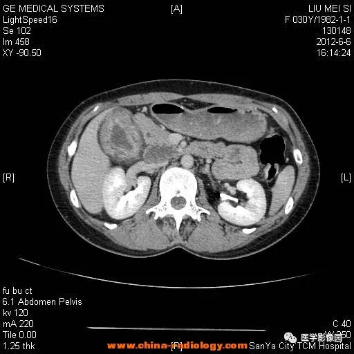 【病例】胆囊腺肌增生症1例CT影像表现 【病例】胆囊腺肌增生症1例CT影像表现