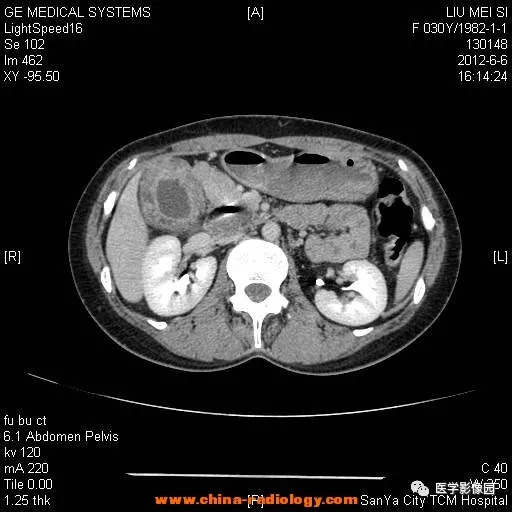 【病例】胆囊腺肌增生症1例CT影像表现 【病例】胆囊腺肌增生症1例CT影像表现