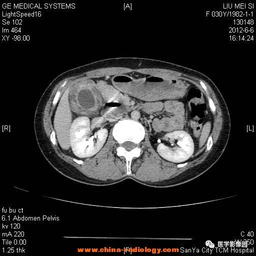【病例】胆囊腺肌增生症1例CT影像表现 【病例】胆囊腺肌增生症1例CT影像表现
