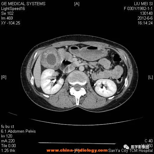 【病例】胆囊腺肌增生症1例CT影像表现 【病例】胆囊腺肌增生症1例CT影像表现