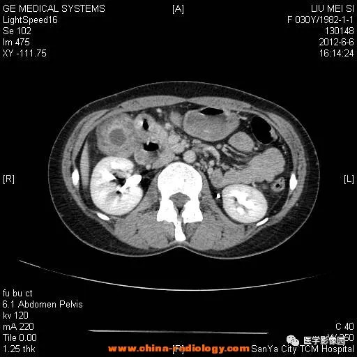【病例】胆囊腺肌增生症1例CT影像表现 【病例】胆囊腺肌增生症1例CT影像表现