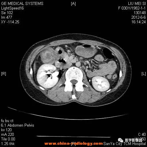 【病例】胆囊腺肌增生症1例CT影像表现 【病例】胆囊腺肌增生症1例CT影像表现