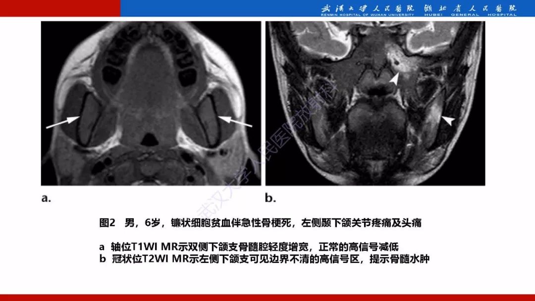 【PPT】系统性疾病累及颅面骨的影像表现