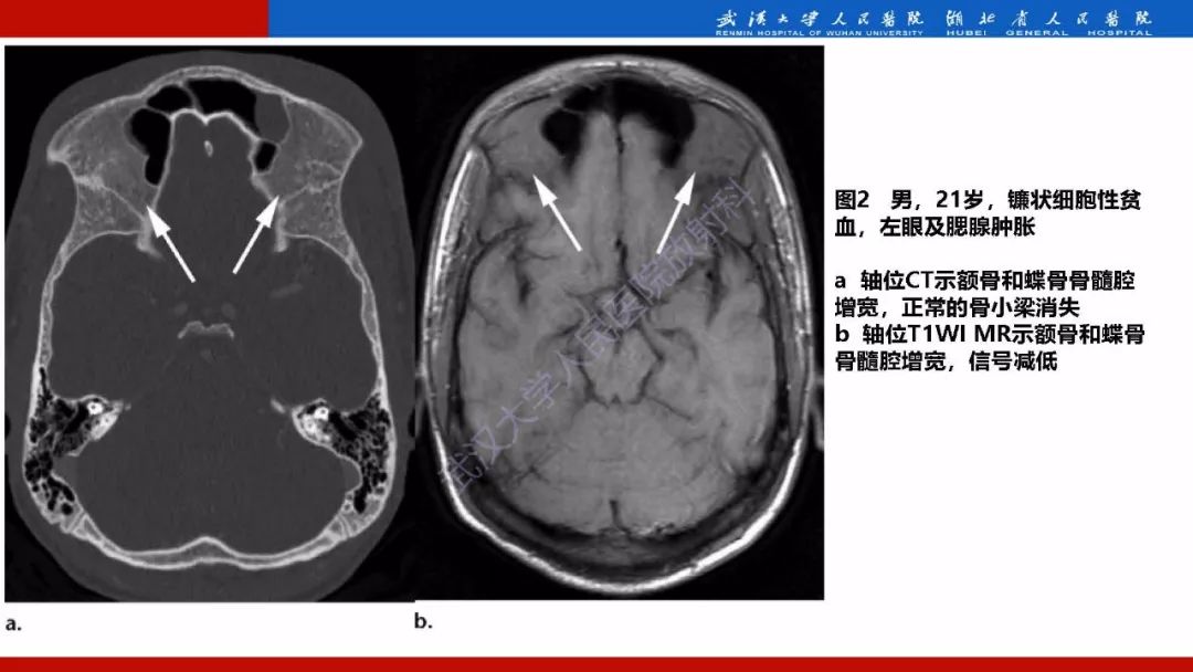 【PPT】系统性疾病累及颅面骨的影像表现