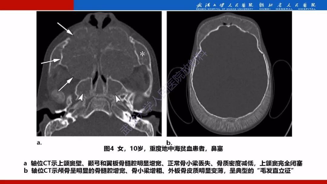【PPT】系统性疾病累及颅面骨的影像表现