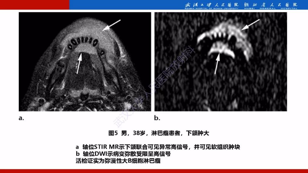 【PPT】系统性疾病累及颅面骨的影像表现