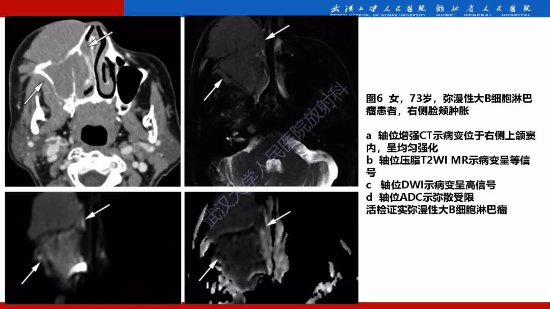 【PPT】系统性疾病累及颅面骨的影像表现