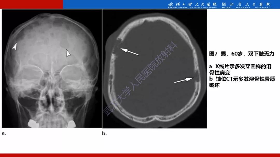 【PPT】系统性疾病累及颅面骨的影像表现