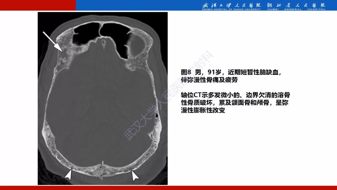 【PPT】系统性疾病累及颅面骨的影像表现