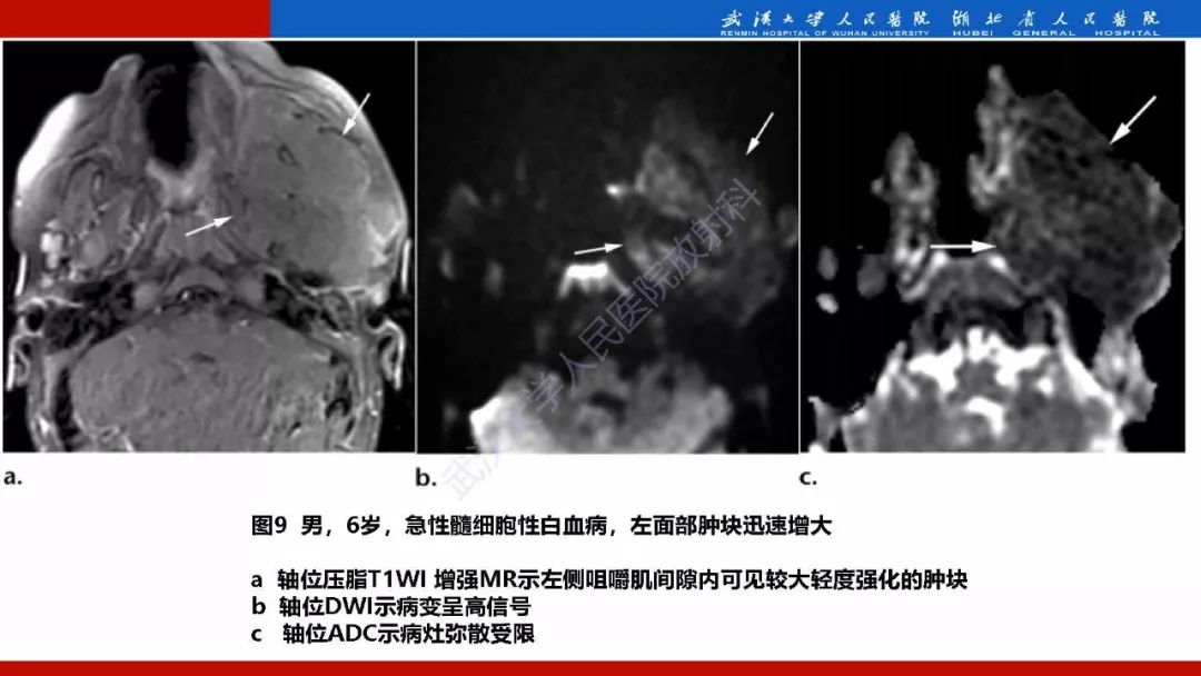 【PPT】系统性疾病累及颅面骨的影像表现