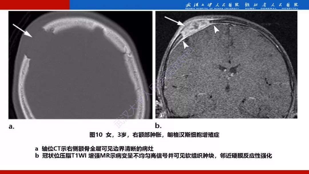 【PPT】系统性疾病累及颅面骨的影像表现