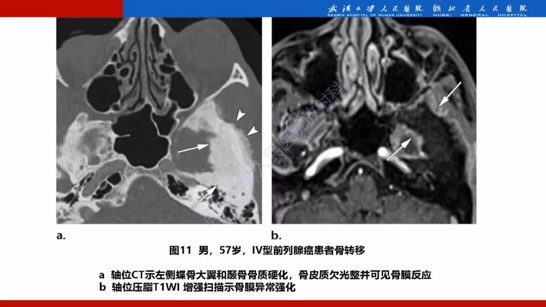 【PPT】系统性疾病累及颅面骨的影像表现