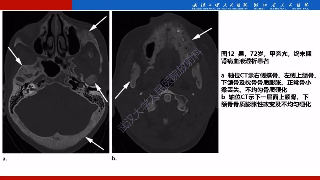 【PPT】系统性疾病累及颅面骨的影像表现