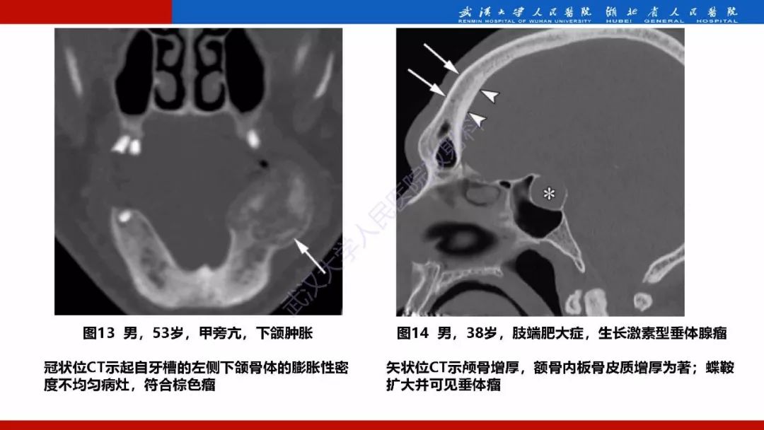 【PPT】系统性疾病累及颅面骨的影像表现