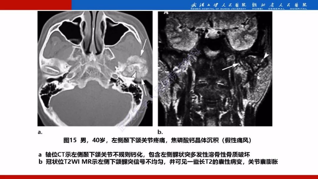 【PPT】系统性疾病累及颅面骨的影像表现