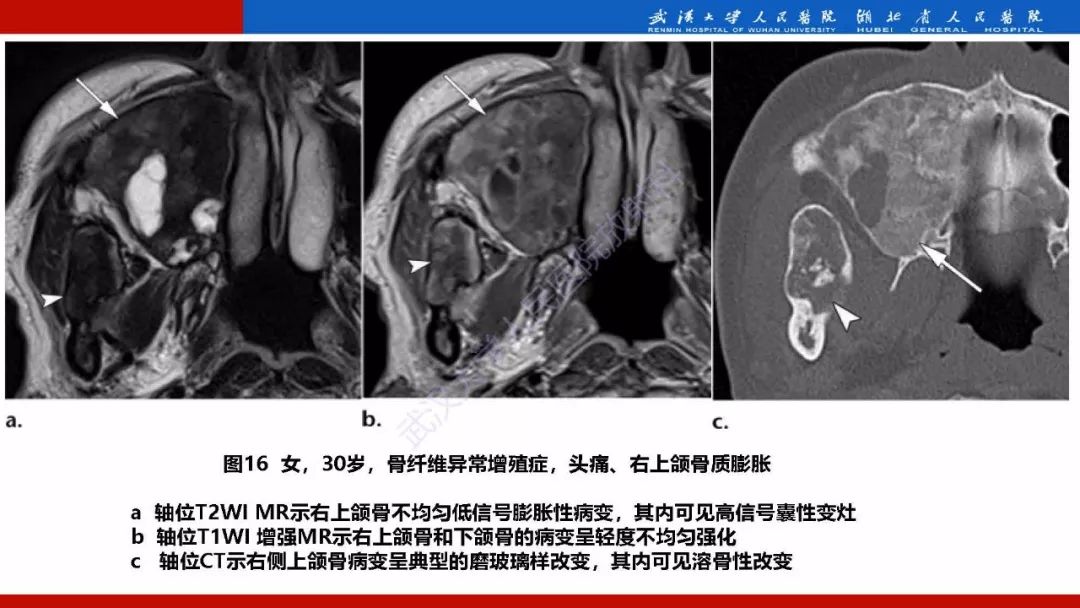 【PPT】系统性疾病累及颅面骨的影像表现