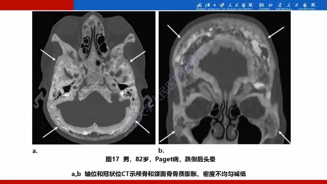 【PPT】系统性疾病累及颅面骨的影像表现