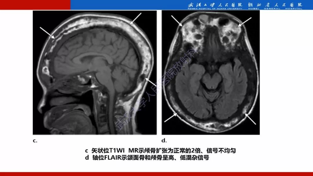 【PPT】系统性疾病累及颅面骨的影像表现