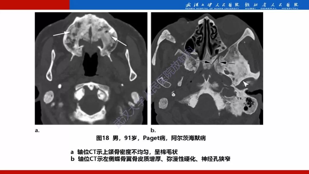 【PPT】系统性疾病累及颅面骨的影像表现