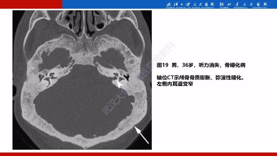 【PPT】系统性疾病累及颅面骨的影像表现