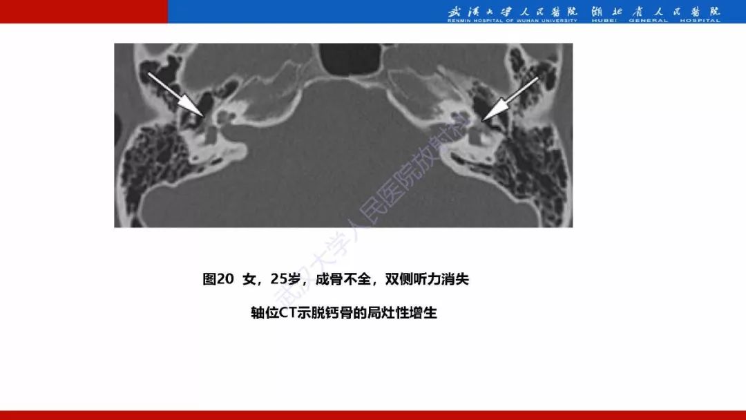 【PPT】系统性疾病累及颅面骨的影像表现