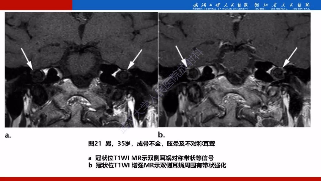 【PPT】系统性疾病累及颅面骨的影像表现