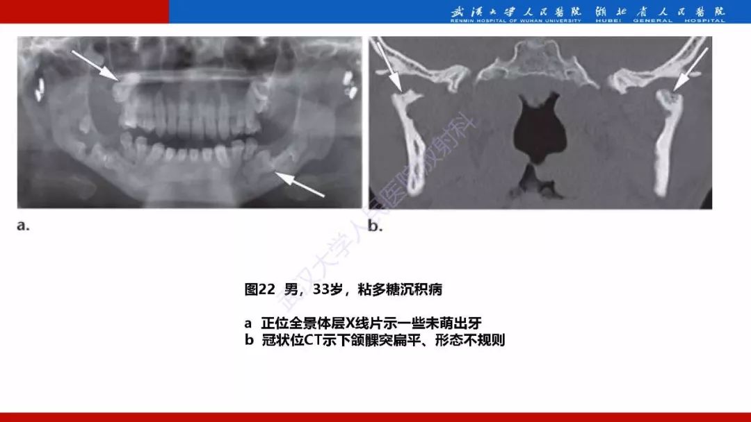 【PPT】系统性疾病累及颅面骨的影像表现