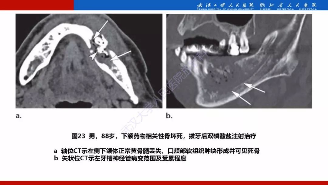 【PPT】系统性疾病累及颅面骨的影像表现