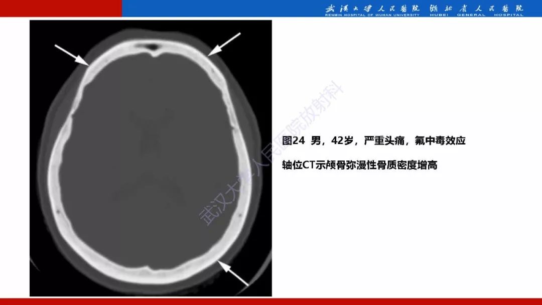 【PPT】系统性疾病累及颅面骨的影像表现
