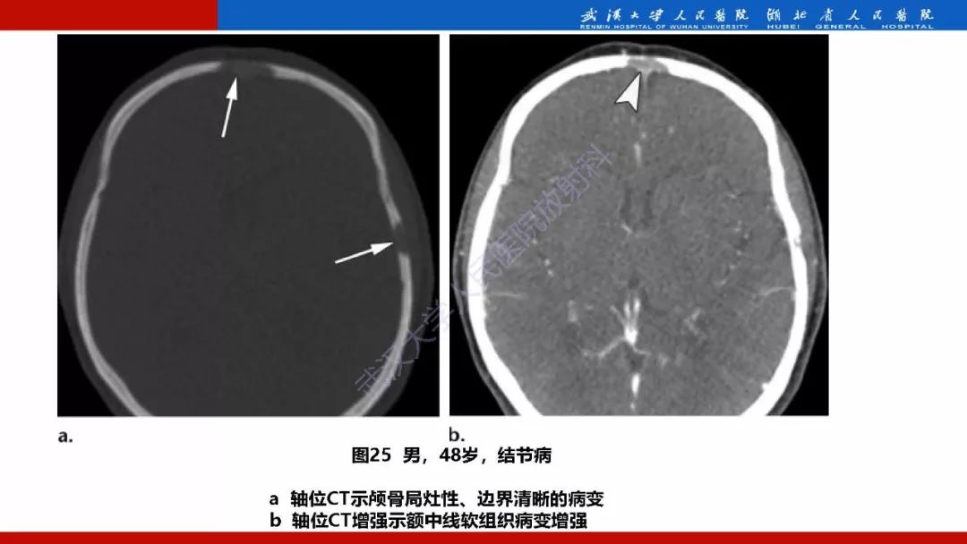 【PPT】系统性疾病累及颅面骨的影像表现
