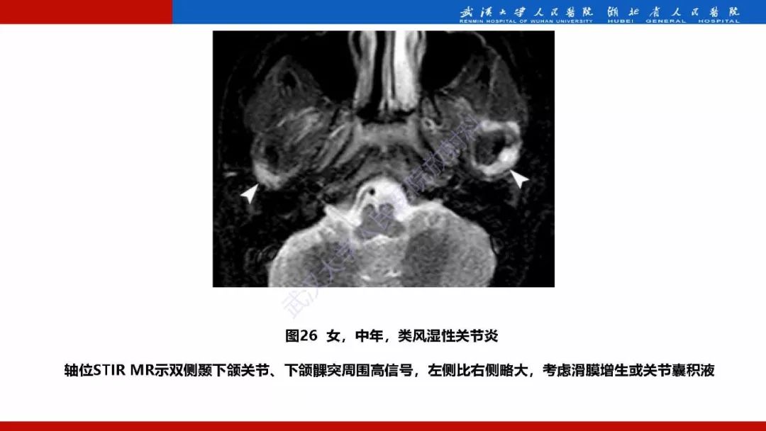 【PPT】系统性疾病累及颅面骨的影像表现